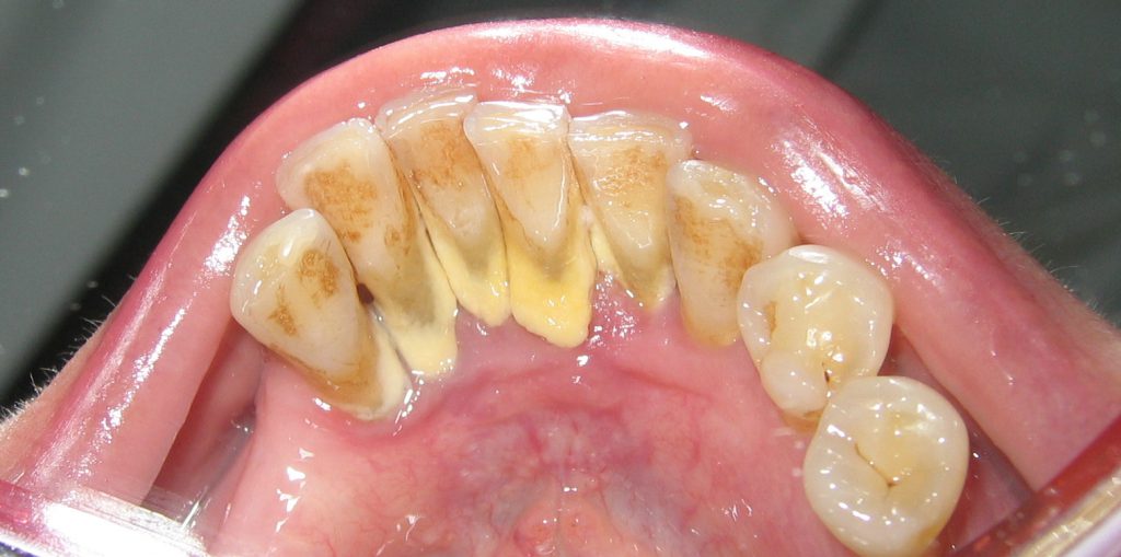 zubni kamenac